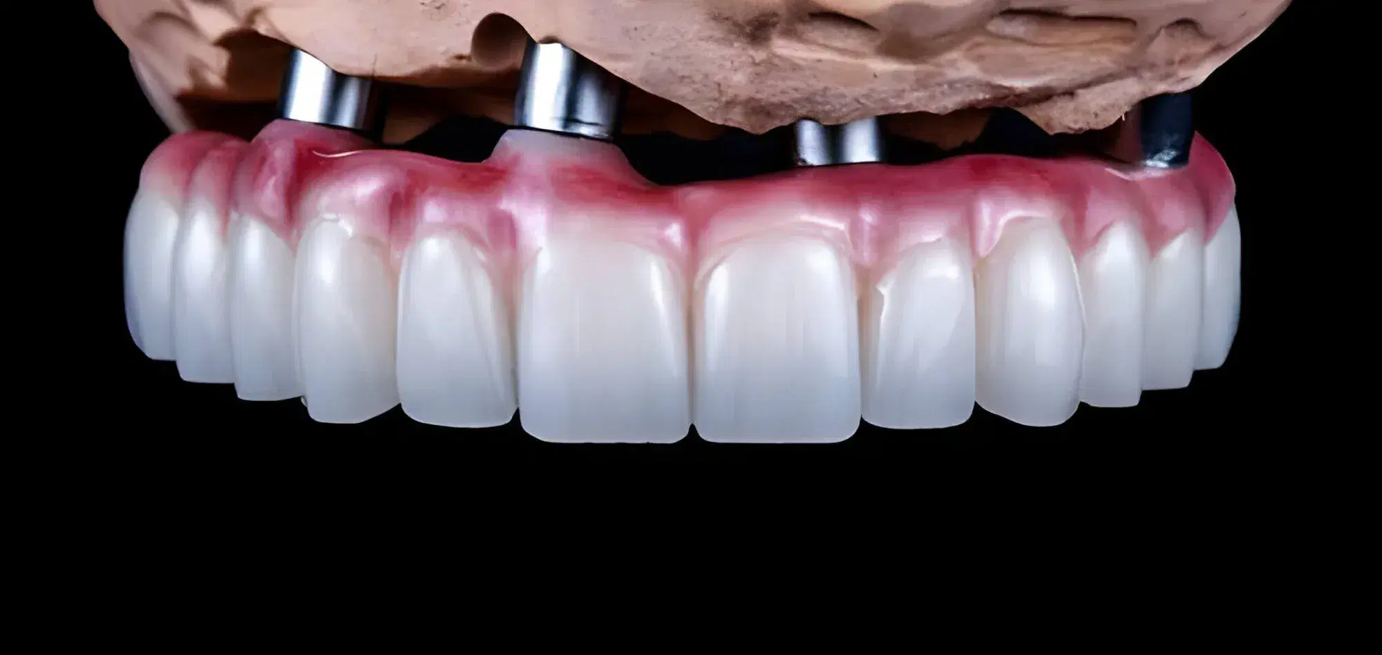 full arch dental implants